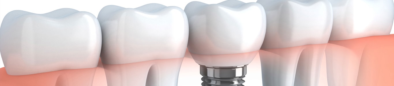 Dental Implants At Dr Sridhar International Dental Hosptial