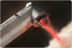 laser dentist hyderabad